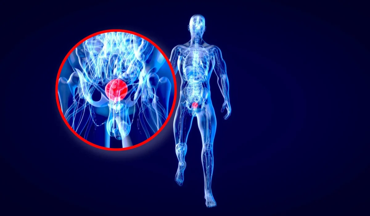 Colorblindness May Increase Mortality Risk in Bladder Cancer Patients, Stanford Study Finds