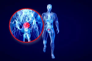 Colorblindness May Increase Mortality Risk in Bladder Cancer Patients, Stanford Study Finds